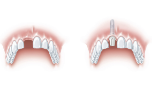 Einzelzahnimplantate