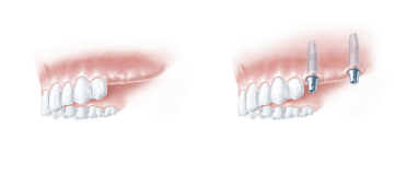 Implantate als Brückenpfeiler