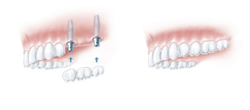 Implantate als Brückenpfeiler finales Ergebnis